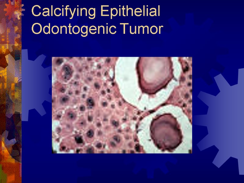 Calcifying Epithelial Odontogenic Tumor